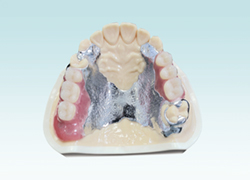 鋳造床義歯